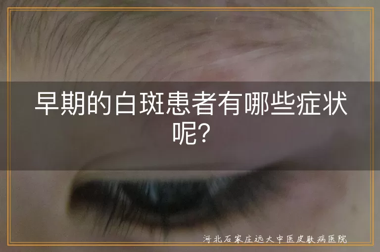 白斑,白癜风,早期症状,皮肤变化,扩散,无症状,阳光敏感