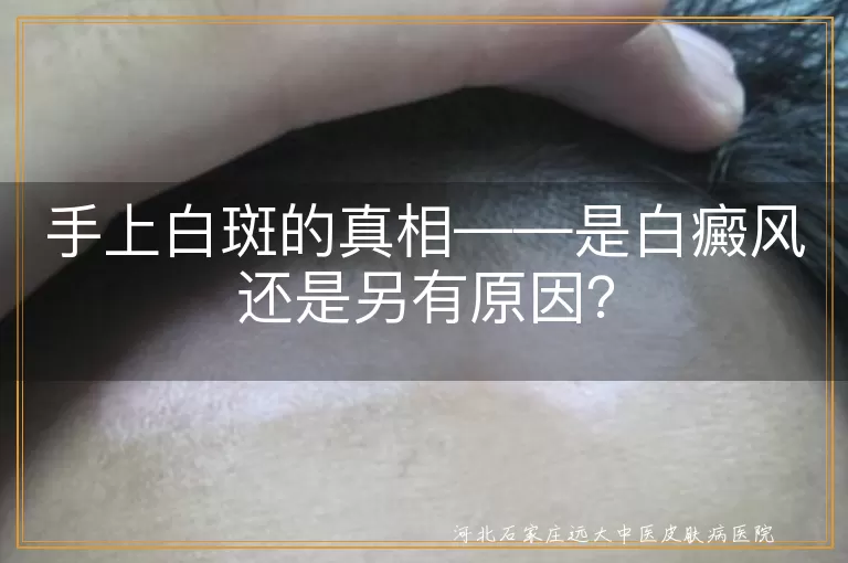 手上白斑,白癜风,皮肤老化,手癣,花斑癣,治疗,自身免疫性疾病