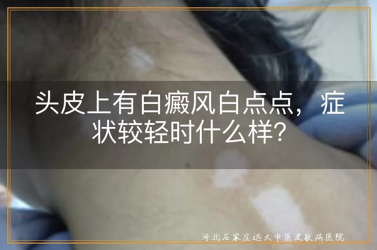白癜风,头皮,白点点,轻微症状,及时就医,头皮护理,生活习惯,避免刺激