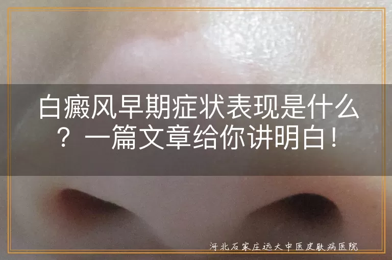 白癜风,早期症状,白斑,皮肤敏感,扩散,其他症状