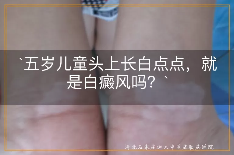 儿童白斑,白癜风,汗斑,脂肪粒,白色糠疹,虫咬反应,无色素痣,预防,护理