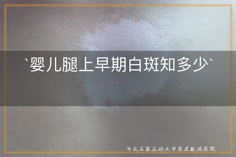 婴儿白斑,白癜风,无色素痣,单纯糠疹,就医检查,日常护理