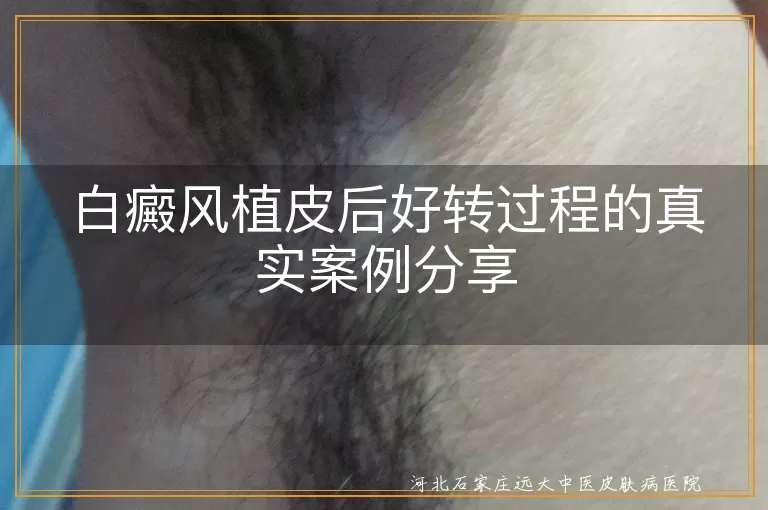 白癜风,植皮手术,好转过程,色素岛,术后护理