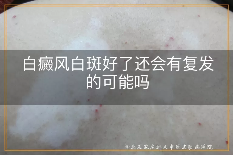 白癜风,复发,免疫系统异常,遗传因素,环境因素,治疗不彻底,健康生活方式,心理支持