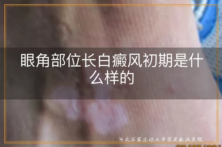 眼角白癜风,初期症状,色素减退斑,就医治疗,日常护理,心态调整