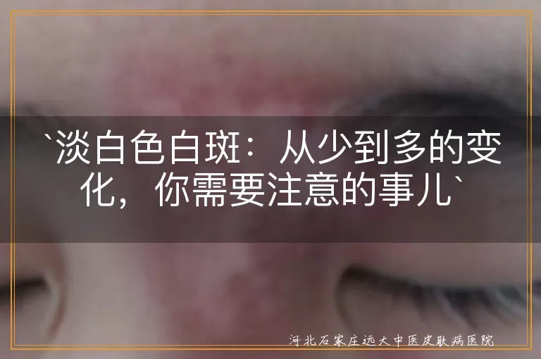 `淡白色白斑`,`皮肤变化`,`阳光照射`,`遗传因素`,`皮肤老化`,`专业咨询`,`心态调整`