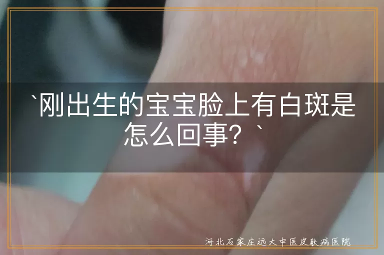`新生儿,白斑,胎记,色素缺失,皮肤干燥,遗传因素,护理,就医`