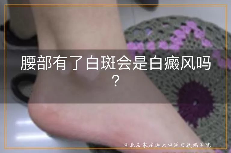 腰部白斑,白癜风,无色素痣,花斑癣,白色糠疹,贫血痣,银屑病,治疗,预防,护理