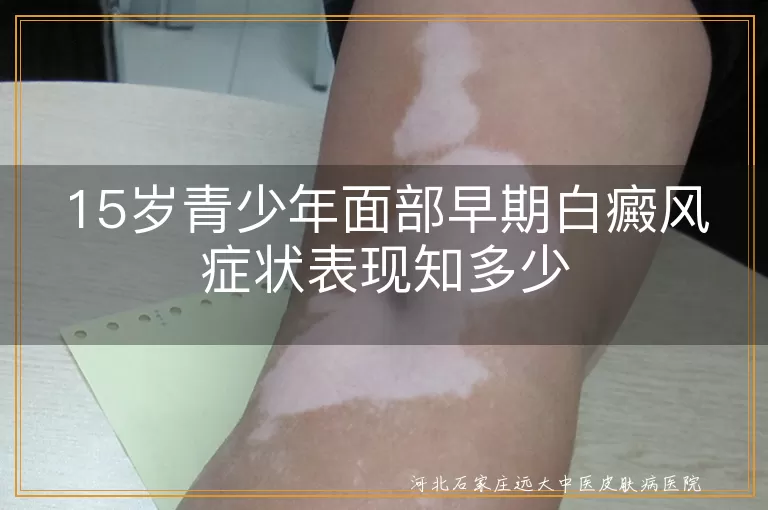 青少年,面部,早期白癜风,白斑,毛发变白,防晒,治疗