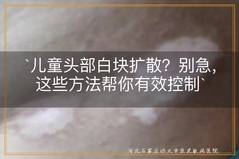 儿童头部白块,扩散,白癜风,头癣,银屑病,花斑糠疹,治疗,护理,心理疏导