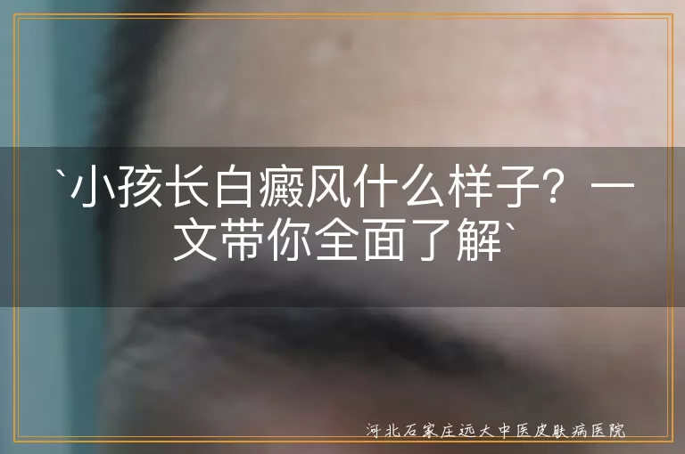 小孩,白癜风,白色斑块,常见部位,应对措施
