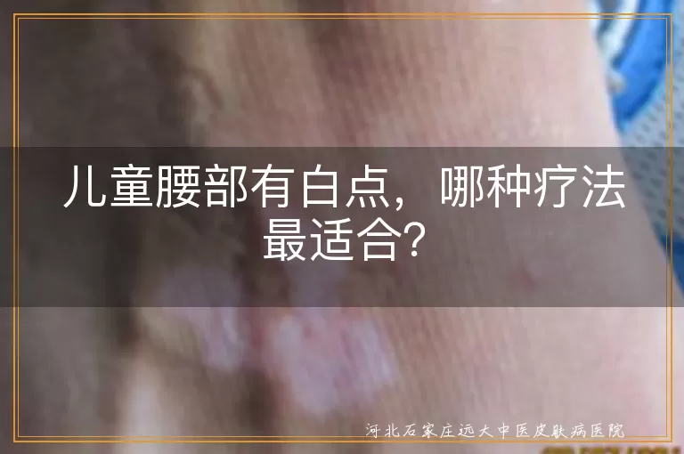 儿童腰部白点,白癜风,花斑糠疹,色素痣,药物治疗,激光治疗,光动力疗法,家长心态调整