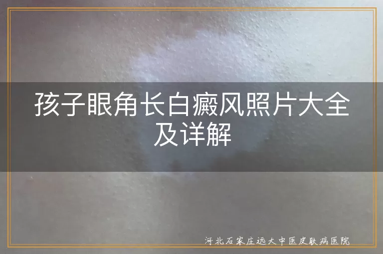 孩子眼角,白癜风,照片,成因,治疗,预防,注意事项