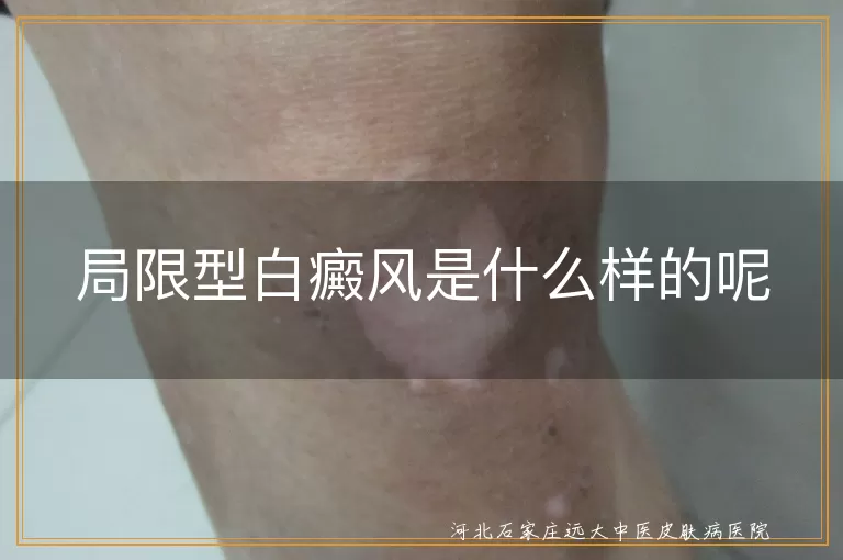 局限型白癜风,白斑,治疗,日常护理,防晒,病因
