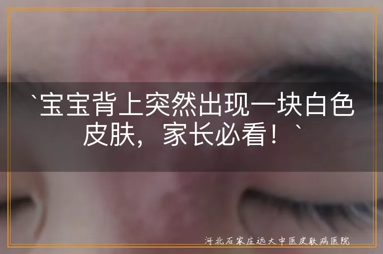 `宝宝,白色皮肤,胎记,色素脱失,皮肤干燥,真菌感染,无色素痣,贫血痣,保湿护理,及时就医`