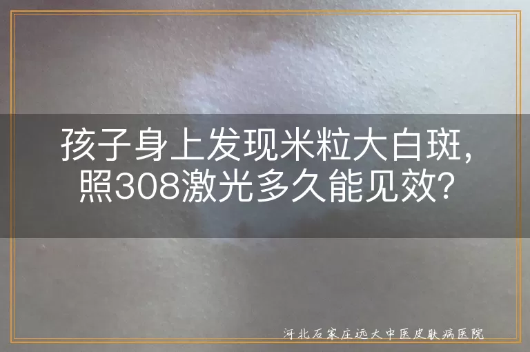 308激光,白斑,儿童,治疗效果,体质差异,病情严重程度,防晒措施,合理饮食,综合治疗