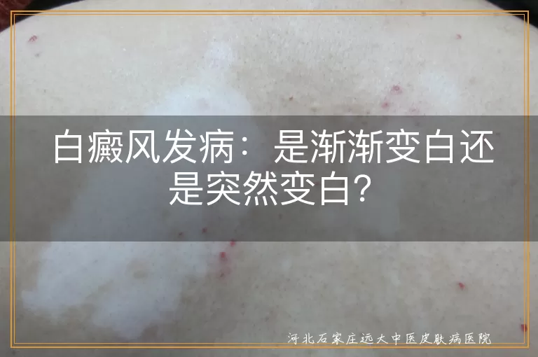 白癜风,发病过程,渐渐变白,突然变白,个人体质,环境因素,生活习惯,应对方法