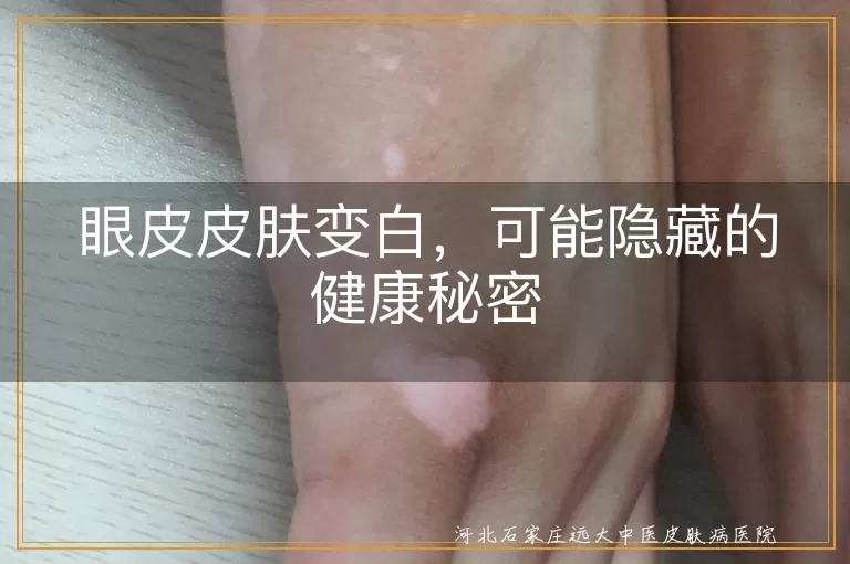 眼皮变白,化妆品残留,贫血,营养不良,皮肤病,血液循环,预防,就医