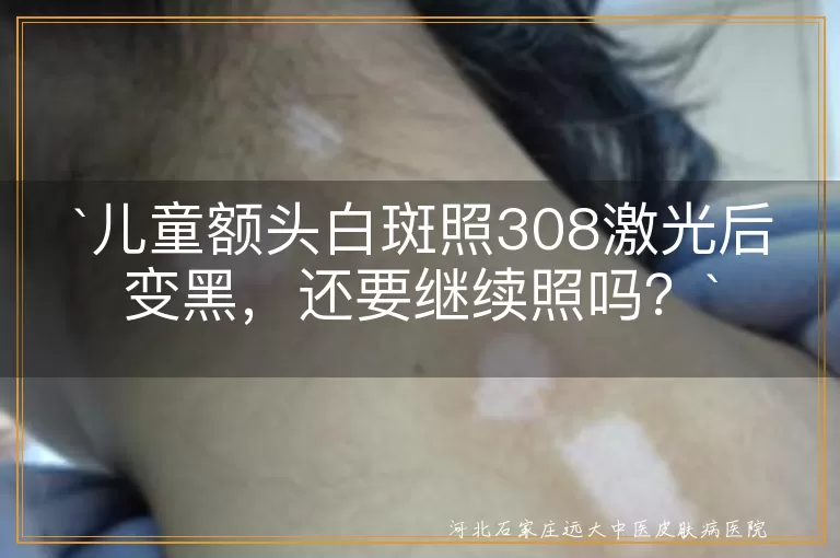 `儿童额头白斑`,`308激光治疗`,`变黑`,`继续治疗`,`医生建议`