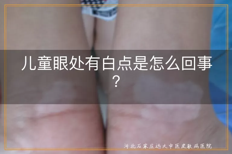 儿童眼处白点,脂肪粒,麦粒肿,白癜风,粟粒疹,痤疮,预防,就医