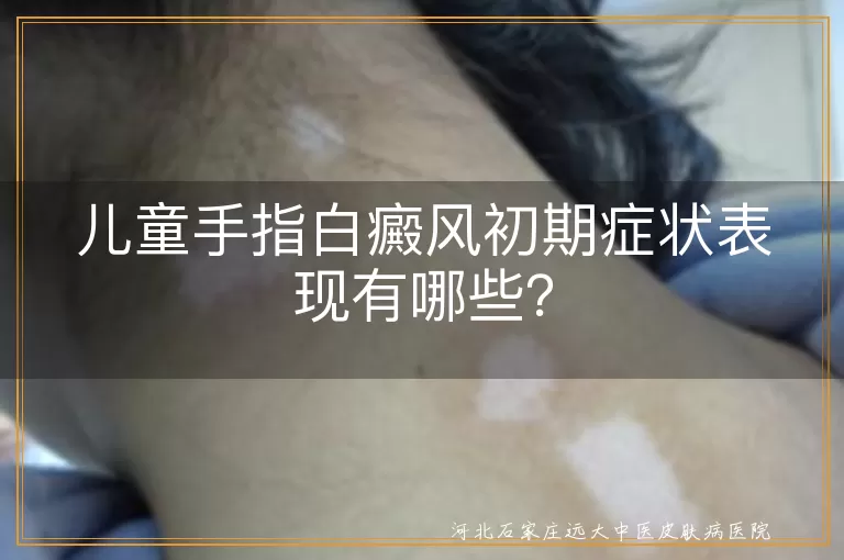 儿童,手指白癜风,初期症状,白斑,皮肤感觉变化,颜色变化,白斑扩散,心理健康