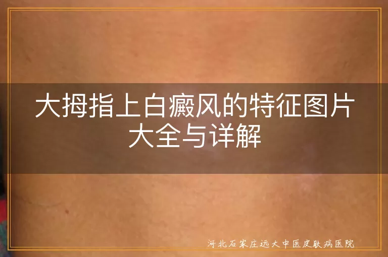 大拇指白癜风,特征,图片,确诊,治疗,科学检查,初期症状,病情发展