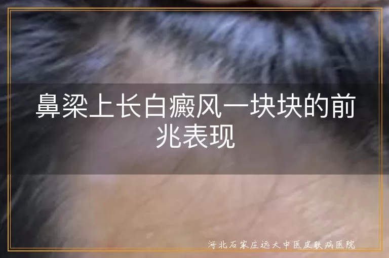 鼻梁白癜风,初期症状,白斑,治疗,护理
