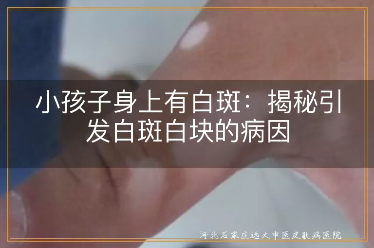 小孩子,白斑,病因,白癜风,白色糠疹,花斑癣,饮食均衡,防晒,刺激性产品