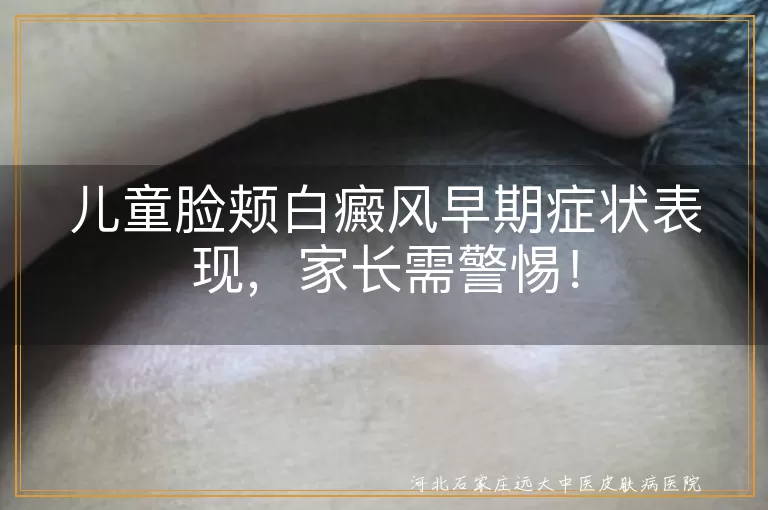 儿童,脸颊白癜风,早期症状,白斑,治疗,预防