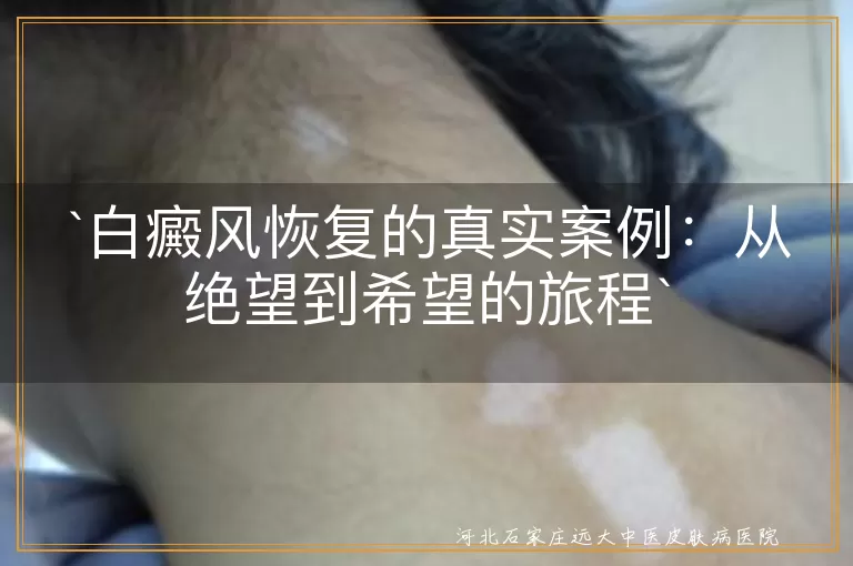 白癜风,恢复,真实案例,希望,坚持,个性化治疗,重拾自信