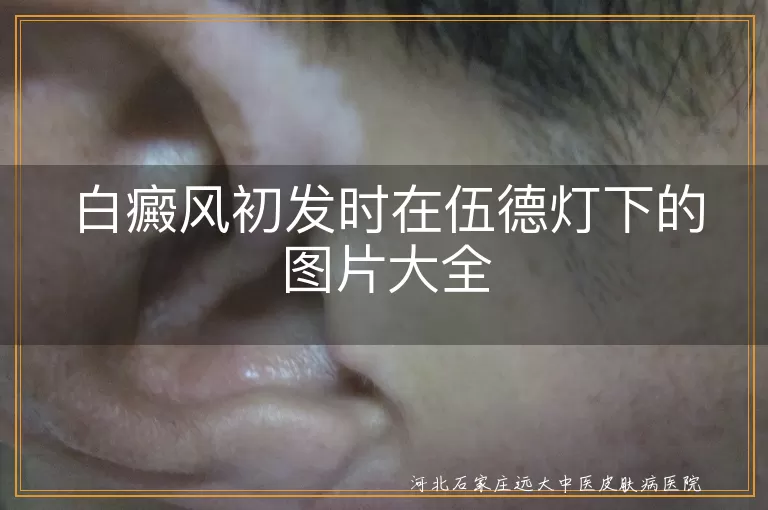 白癜风,伍德灯,荧光反应,隐形白斑,早期诊断