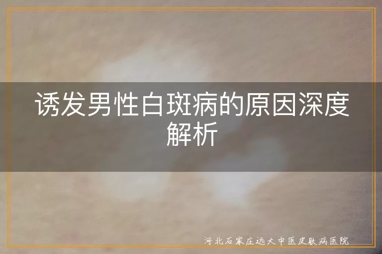男性白斑病,自身免疫因素,遗传因素,神经化学因素,内分泌因素,紫外线照射,化学物质,药物副作用,预防措施
