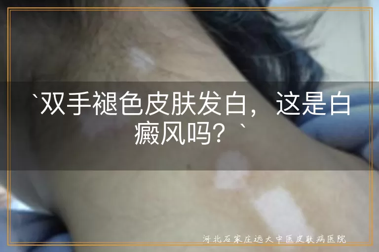 双手褪色,皮肤发白,白癜风,原因,判断,治疗,预防