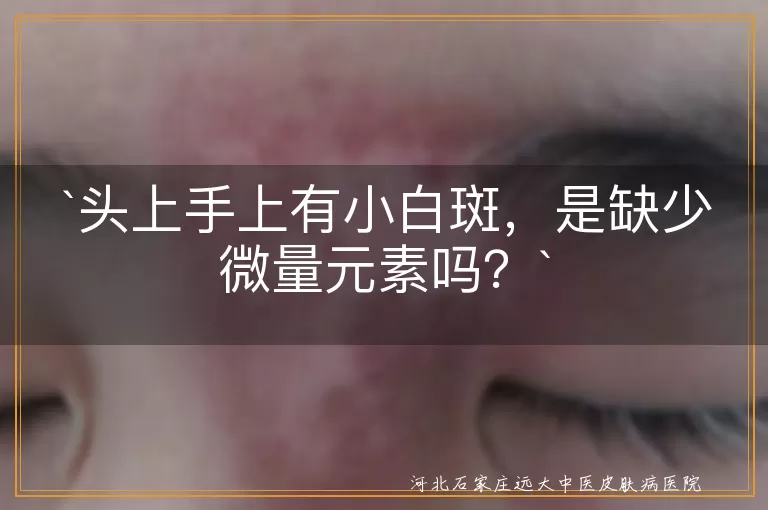 小白斑,微量元素,皮肤问题,阳光暴晒,皮肤老化,皮肤炎症,遗传因素,专业医生
