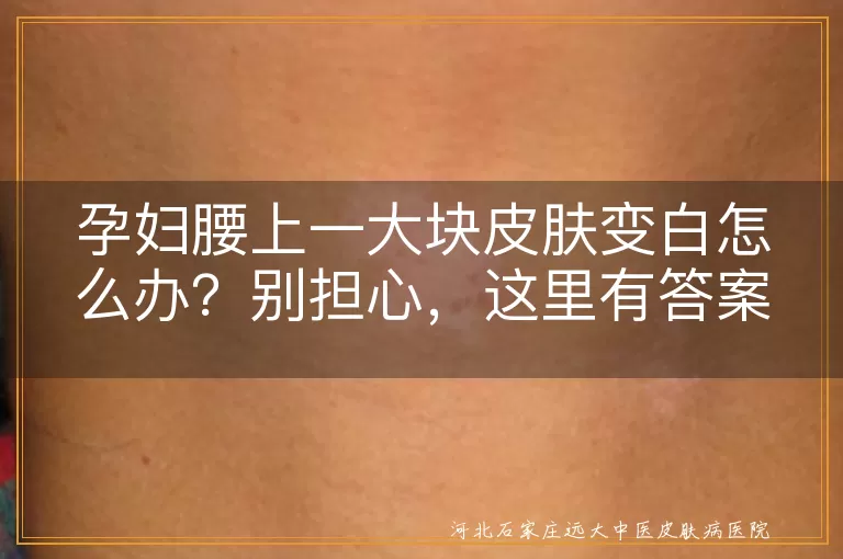 孕妇,皮肤变白,色素减退,白色糠疹,保湿,防晒,饮食调理,咨询医生