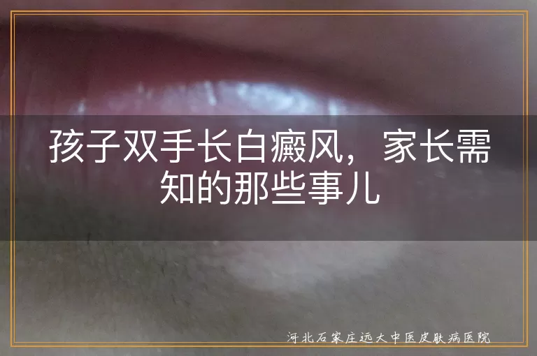 孩子,双手,白癜风,治疗,护理,预防,家长,就医