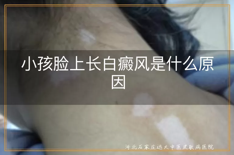小孩,白癜风,原因,遗传,饮食,环境,外伤,免疫系统,精神因素