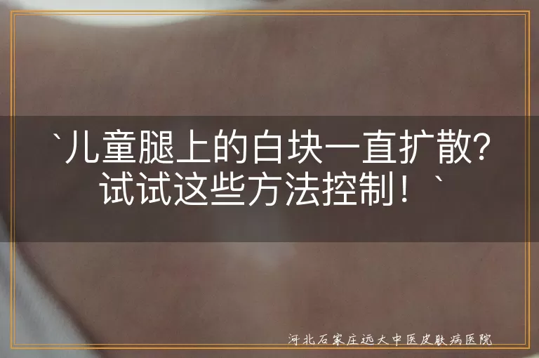 儿童白块扩散,白癜风,花斑癣,白色糠疹,无色素痣,贫血痣,治疗方法,日常护理,心态调整