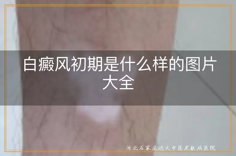 白癜风初期,淡白色斑点,黄豆大小,无自觉症状,发病部位不固定,及时就医,保持良好心态