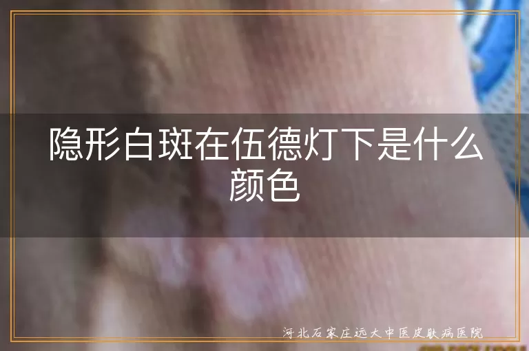 隐形白斑,伍德灯,亮白色,蓝白色荧光,白癜风,治疗,护理