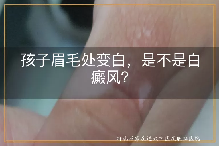孩子眉毛变白,白癜风,白色糠疹,无色素痣,预防治疗,日常护理