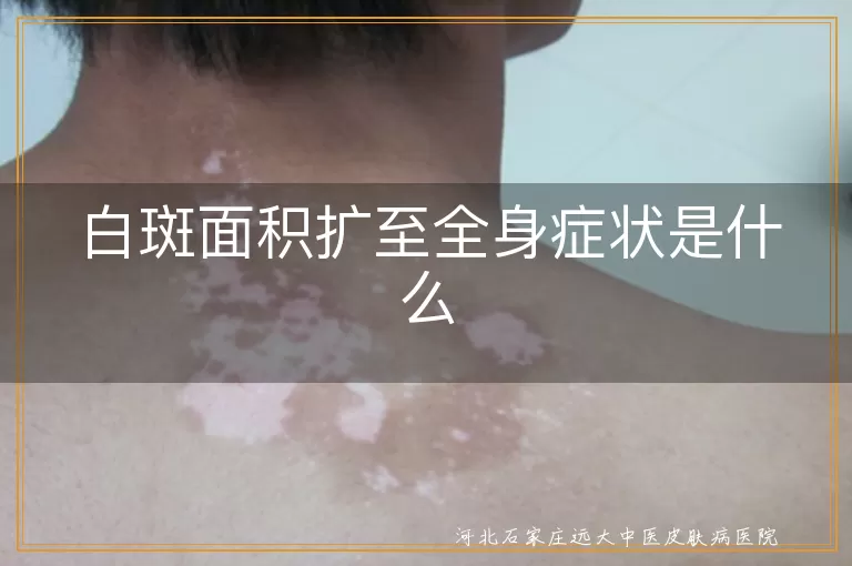 白斑扩散,全身症状,颜色变化,数量激增,就医治疗,生活习惯,心理调适,预防小贴士