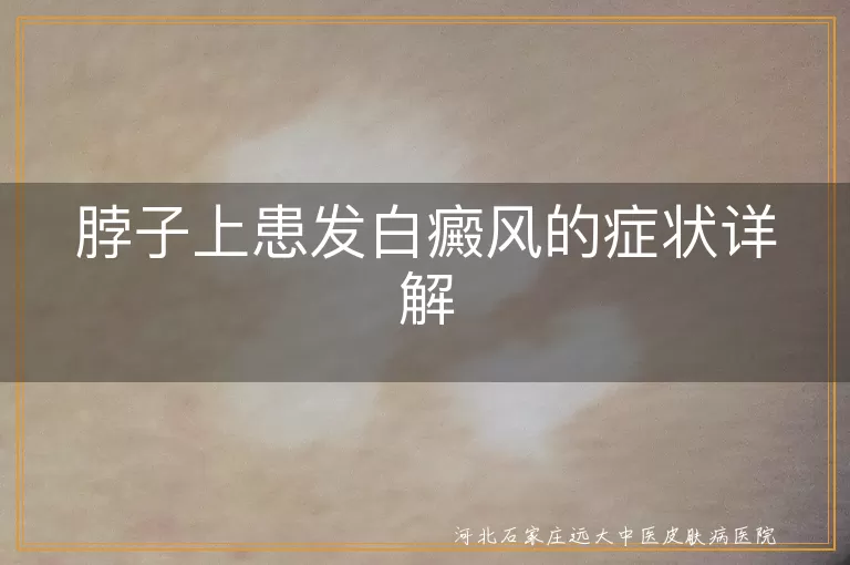 白癜风,脖子,皮肤发白,瘙痒,毛发变白,阳光敏感,疼痛,脱屑,及时就医