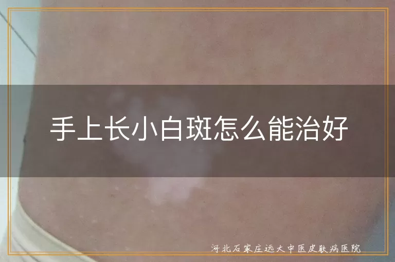 手上小白斑,白癜风,银屑病,花斑糠疹,专业诊断,精准治疗,日常护理,良好心态