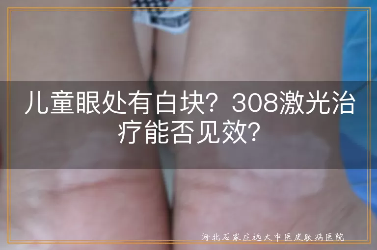 儿童眼角白块,白癜风,308激光治疗,安全性,见效快,抗复发,专业检测,眼部保护,合理饮食,后续护理