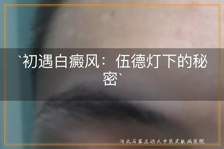 白癜风,伍德灯,蓝白色斑,早期发现,早期治疗,坚持,胜利