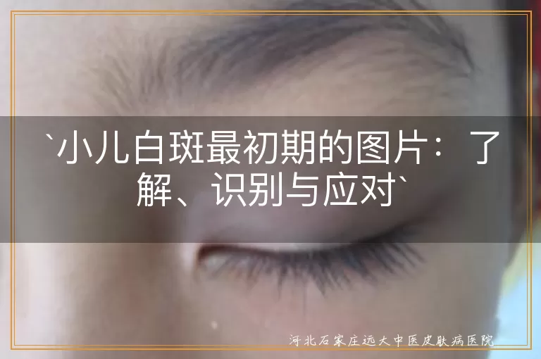 小儿白斑,最初期图片,识别,应对,保湿,防晒,均衡饮食,及时就医