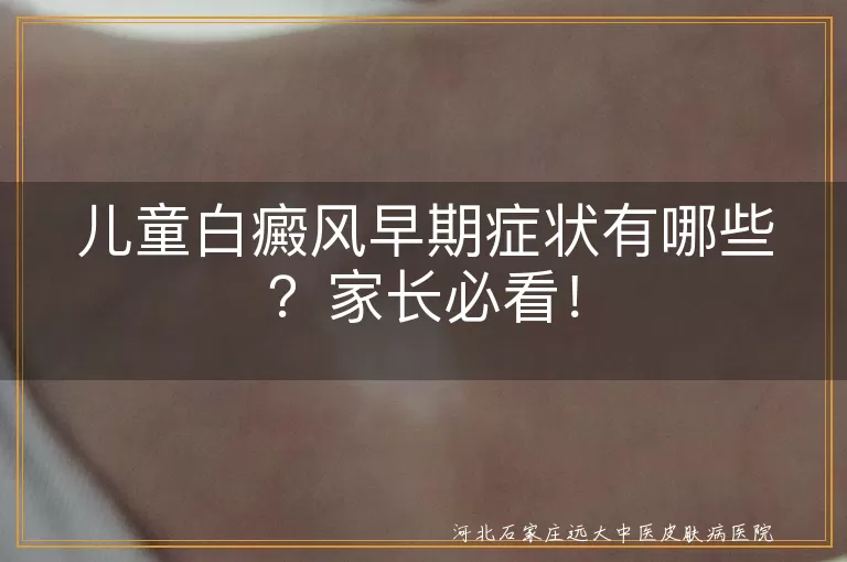 儿童白癜风早期症状有哪些？家长必看！