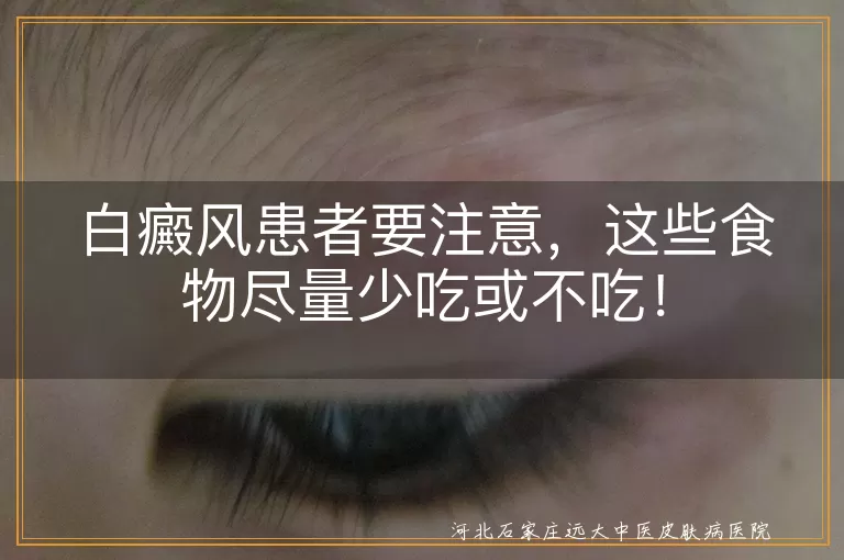 白癜风,饮食注意,富含维生素C的食物,辛辣刺激性食物,海鲜及发物,添加剂食品,少饮酒,过酸过甜食物