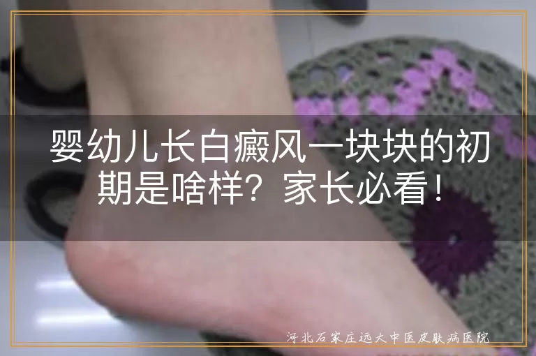 婴幼儿,白癜风,白斑,初期症状,遗传,免疫系统,物理疗法,关心支持
